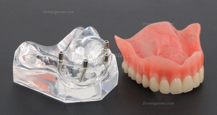 Anatomisches Modell der Zahnz&auml;hne &Uuml;berprothese Superior mit 4 Implantaten Demo Modell 6001